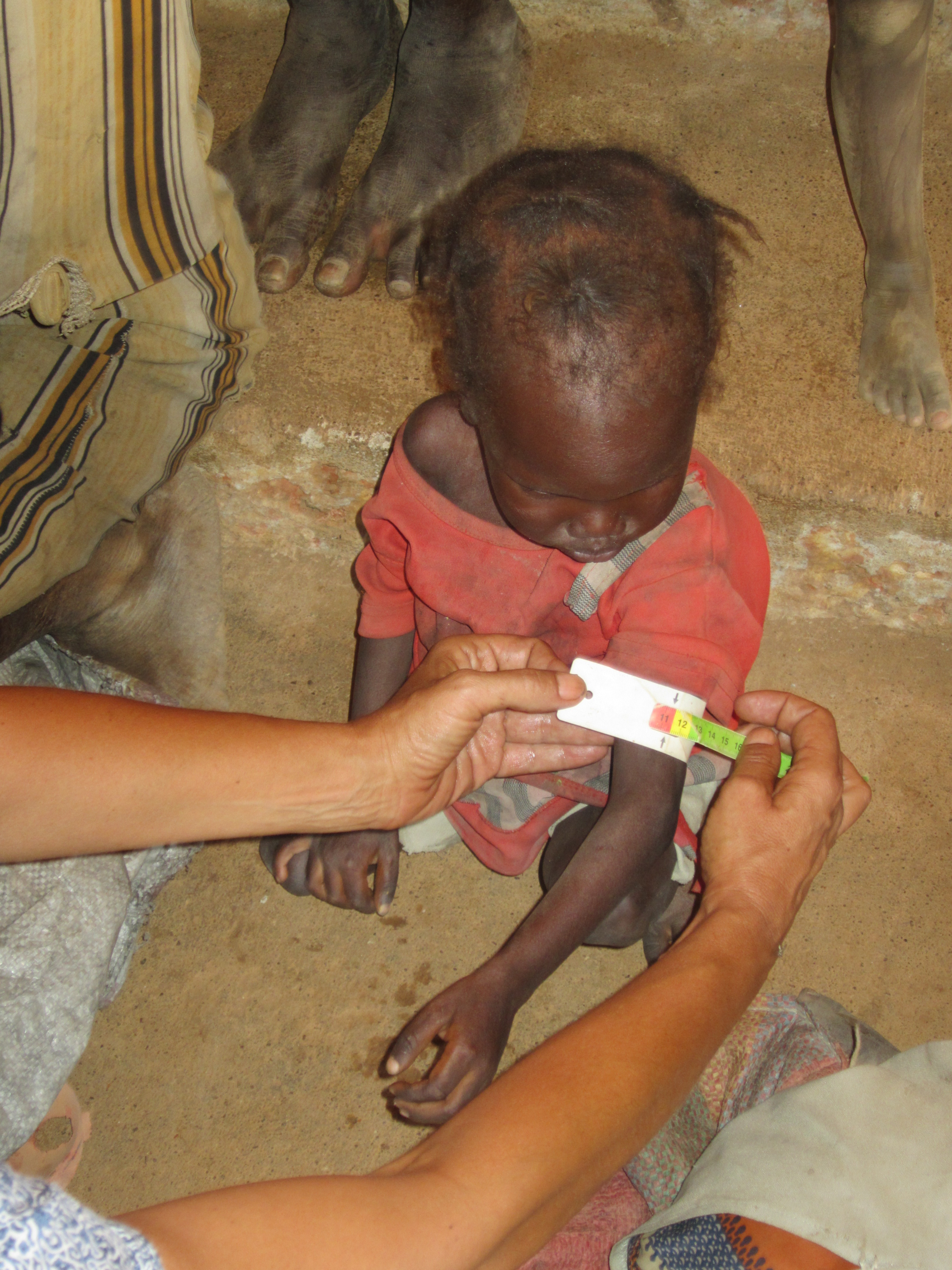 Malnourished Child in Wau.JPG